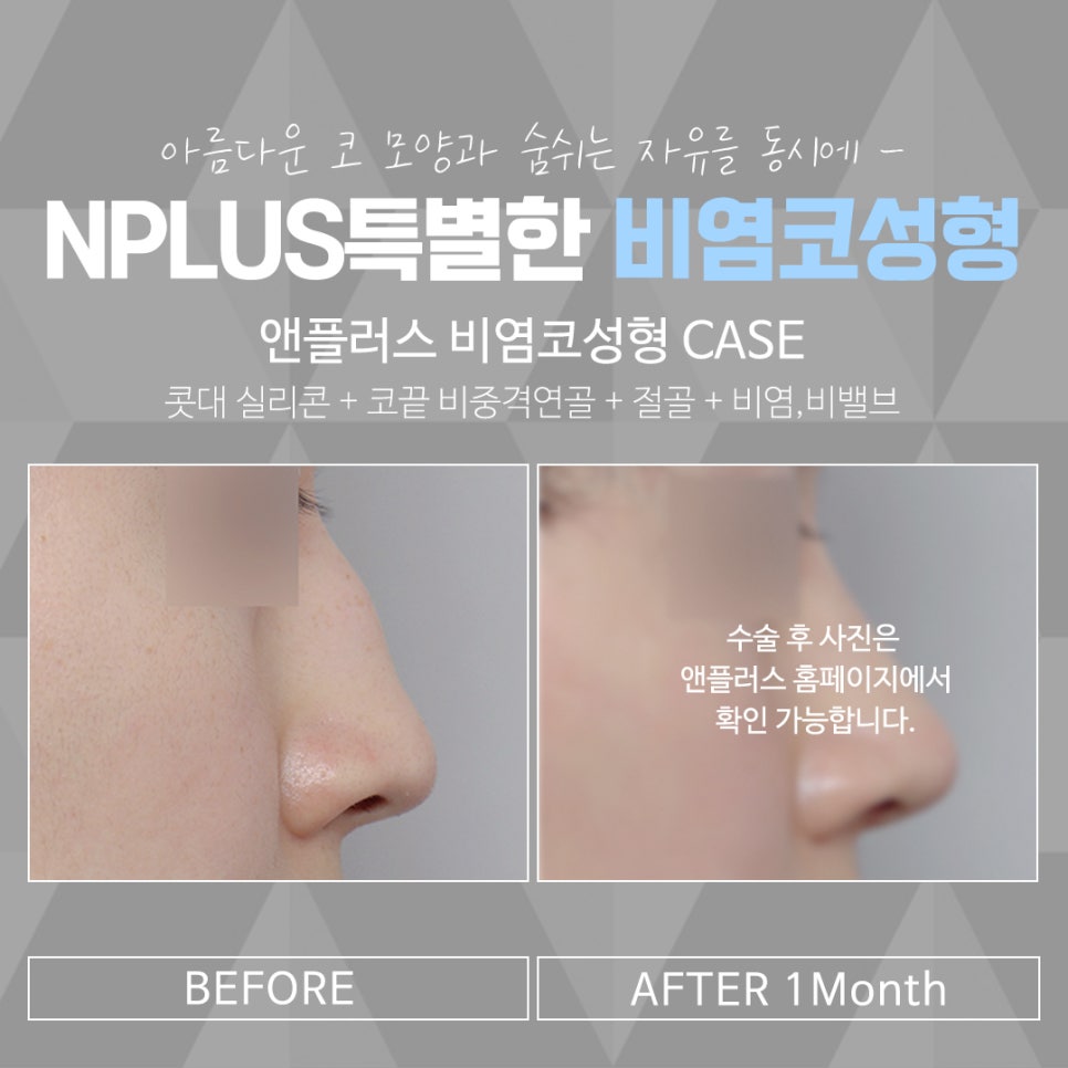 The Importance of Choosing a Nasal Surgery Review image 16