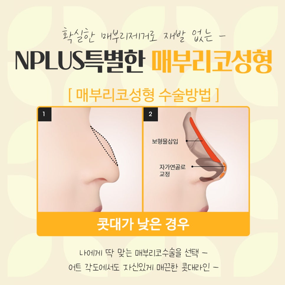 Detailed Review of Hump Nose Surgery, Including Function image 9