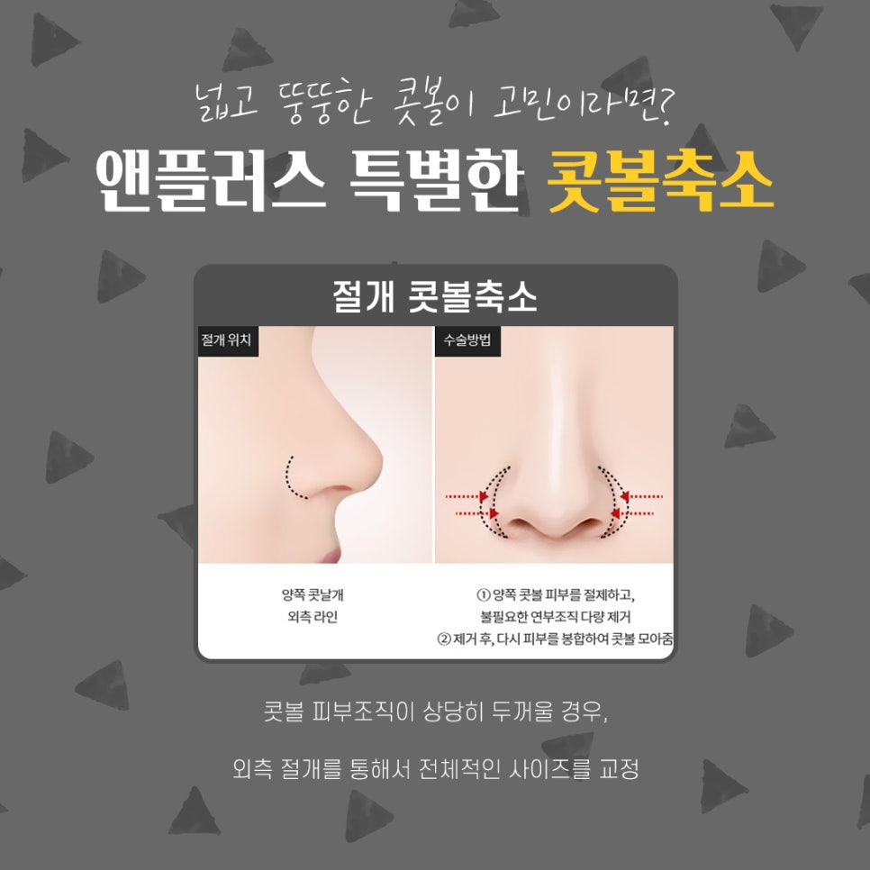 콧볼축소후기_넓은콧볼 고민해결 관련 이미지 7
