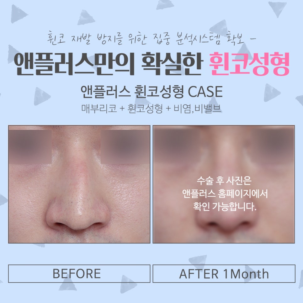 휜코성형 정확한 문제 파악으로 관련 이미지 15