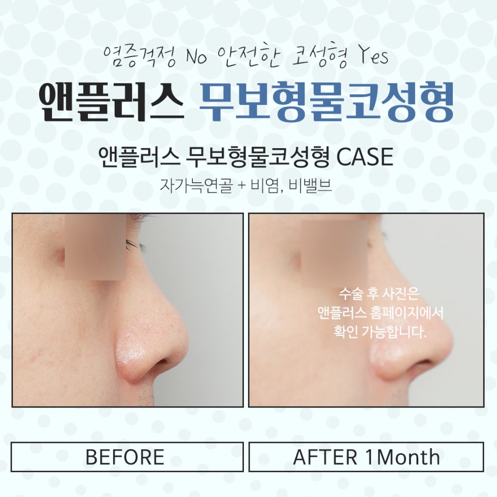무보형물코수술을 통해 자연스러운 코라인으로 관련 이미지 14