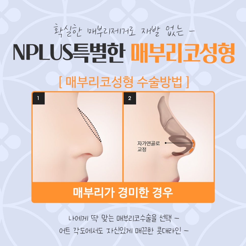 매부리코성형후기 매부리코 잘하는 곳에서 관련 이미지 12