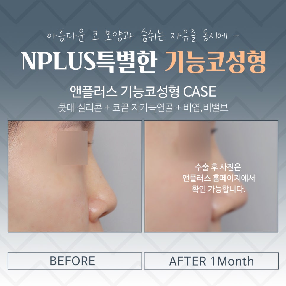 If You Are Looking in Detail at Functional Nose Surgery Before and After image 15