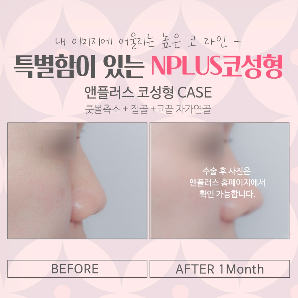 서울코수술잘하는곳 꼼꼼하게 알아보고 관련 이미지 13