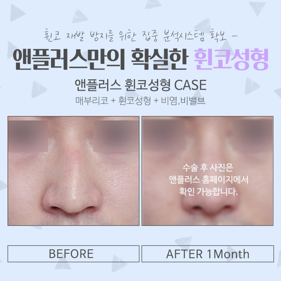 Taking a Thorough Look at Functional Deviated Nose Surgery image 16