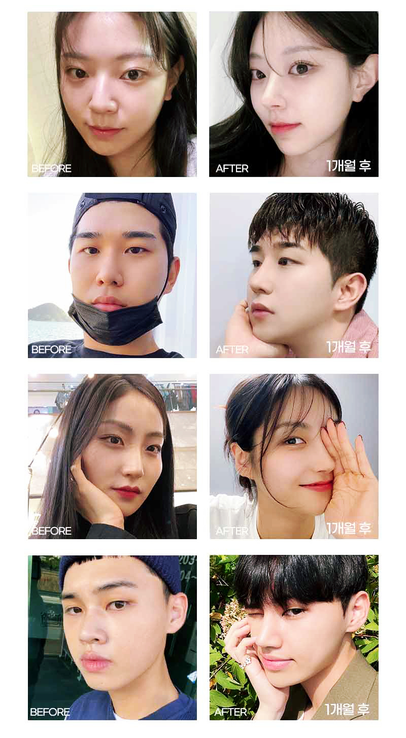 앤플러스 자가늑코성형은 예쁘다! 관련 이미지 3