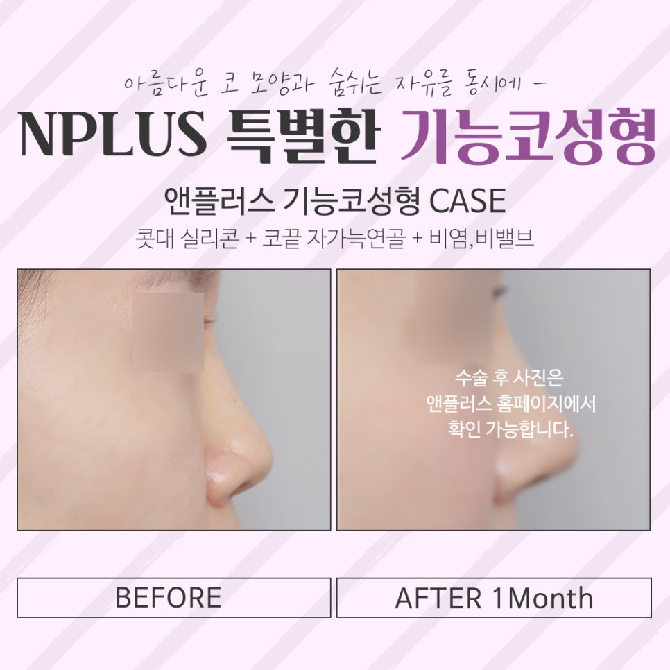Before and After Female Nose Surgery in Various Ways image 12