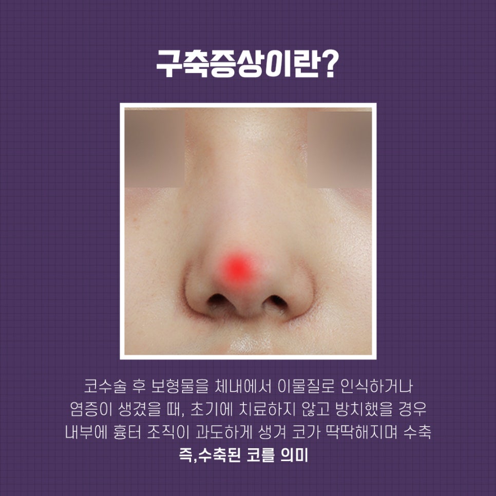 Contracted Nose Surgery_ Make Your Last Nose Surgery More Satisfying image 3