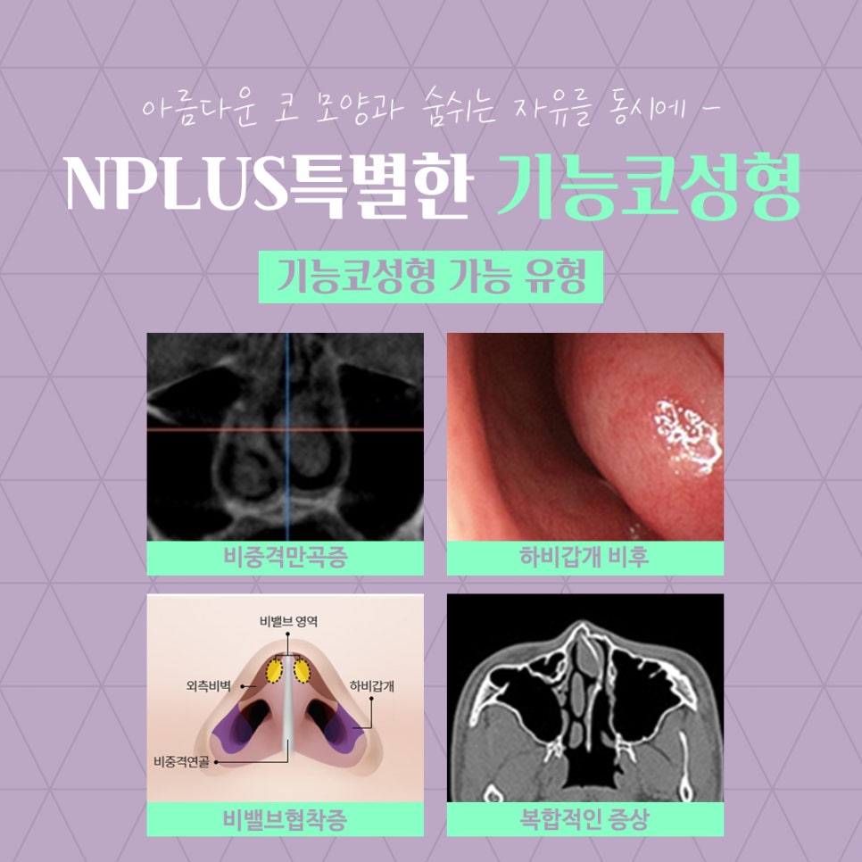 앤플러스의원에서 알려드리는 기능코성형 관련 이미지 6
