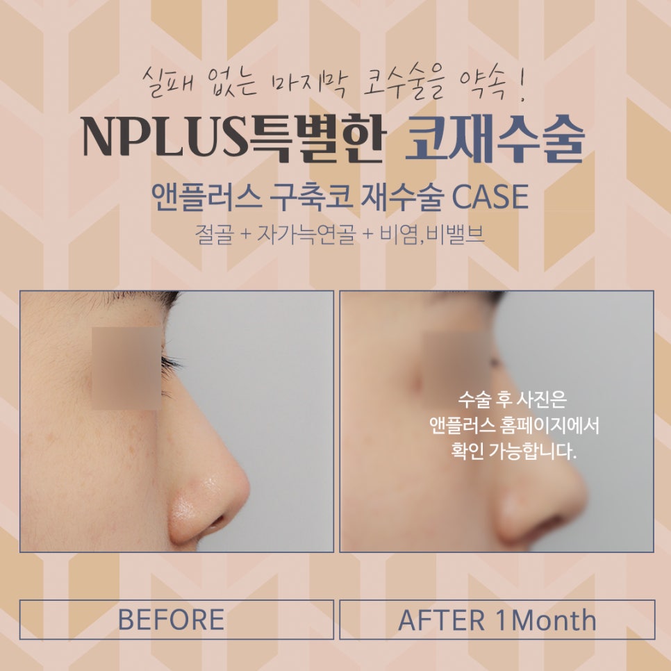 자가늑연골 활용한 코재수술후기 관련 이미지 11
