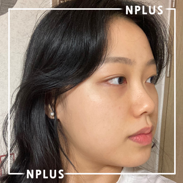 코재건 수술할때 꼭 알아두어야 할 상식! 관련 이미지 2