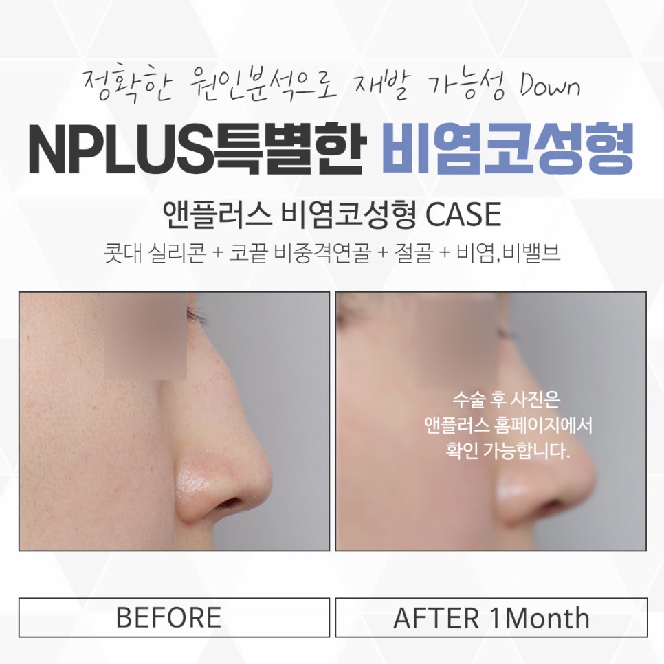 Nasal Surgery and Rhinoplasty: Identifying the Exact Cause image 15