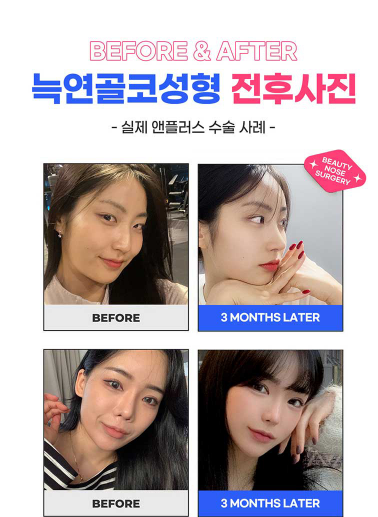 앤플러스의원 자가늑코성형 이벤트😍 관련 이미지 4