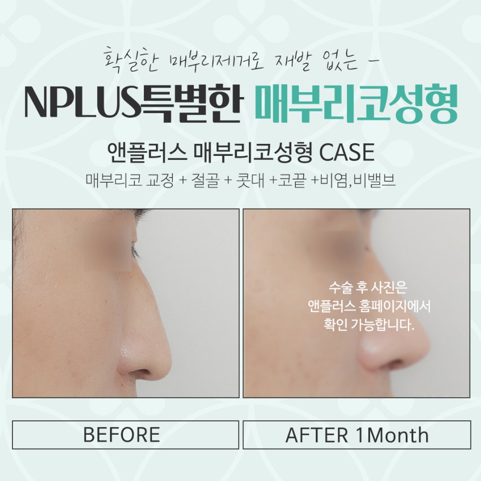 매부리코수술후기 자연스럽고 세련된 라인으로 관련 이미지 16