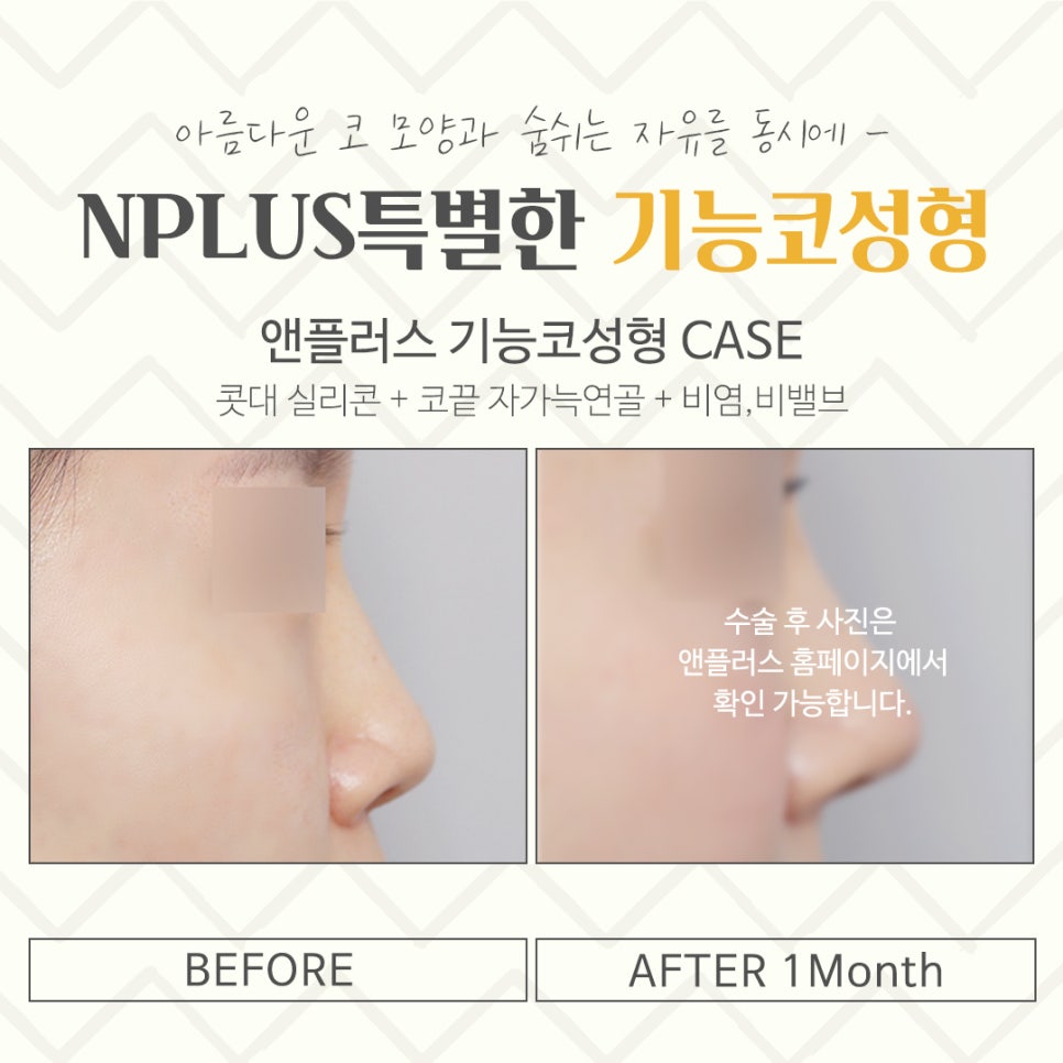 기능코성형후기 이미지를 고려하여 관련 이미지 15