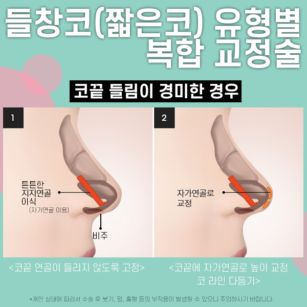 짧은코성형 복합적 교정방법 관련 이미지 4