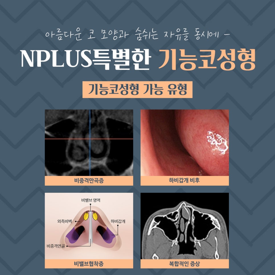 기능코성형후기 정확한 원인 분석으로 관련 이미지 6