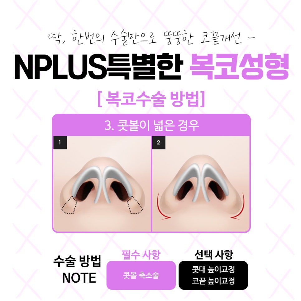 복코수술후기 자연스럽고 예쁜 라인으로 관련 이미지 9