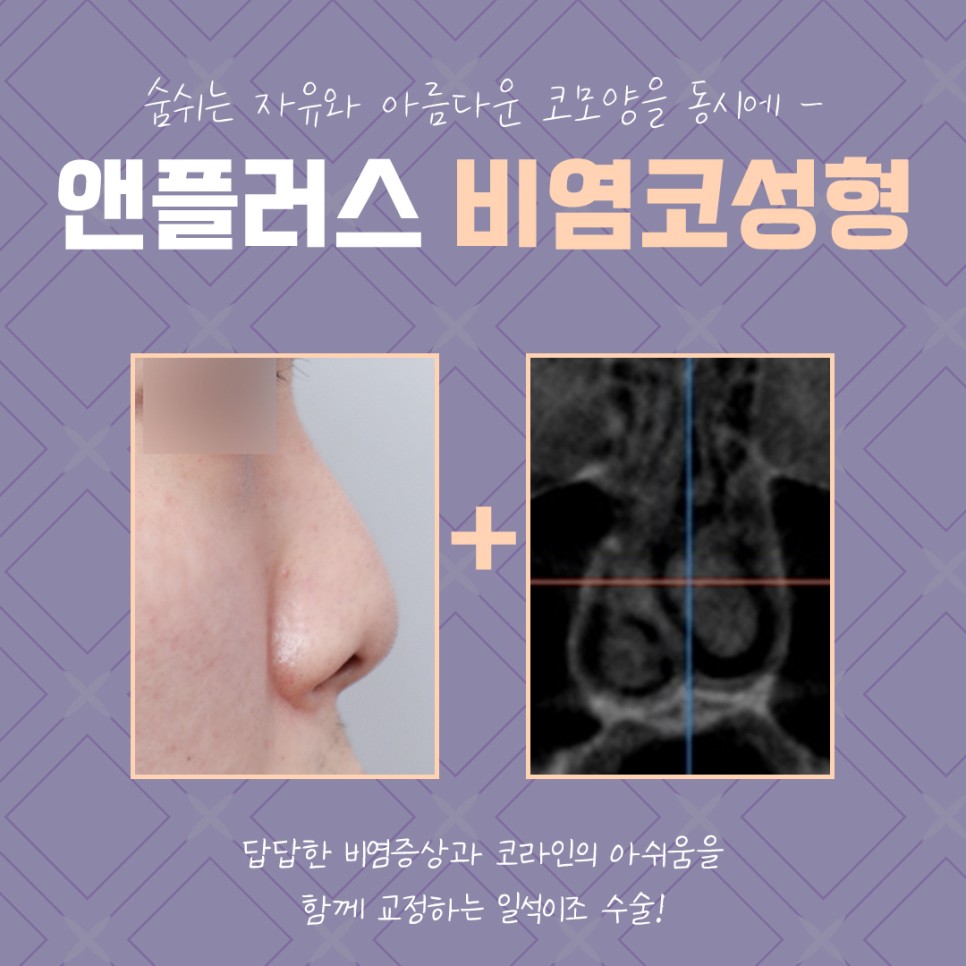 Looking Into Rhinitis Rhinoplasty Reviews and Benefits image 7