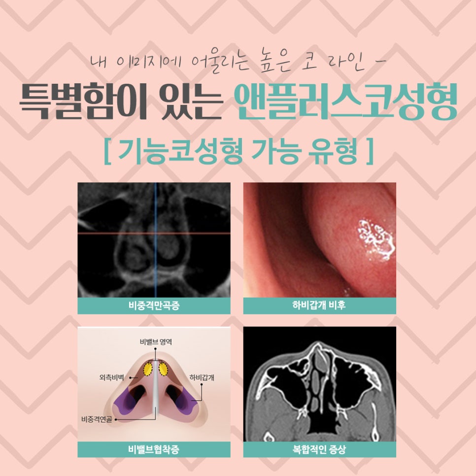 Nose Surgery Review Considering the Straight-Humped, Straight-Half-Moon Line image 6