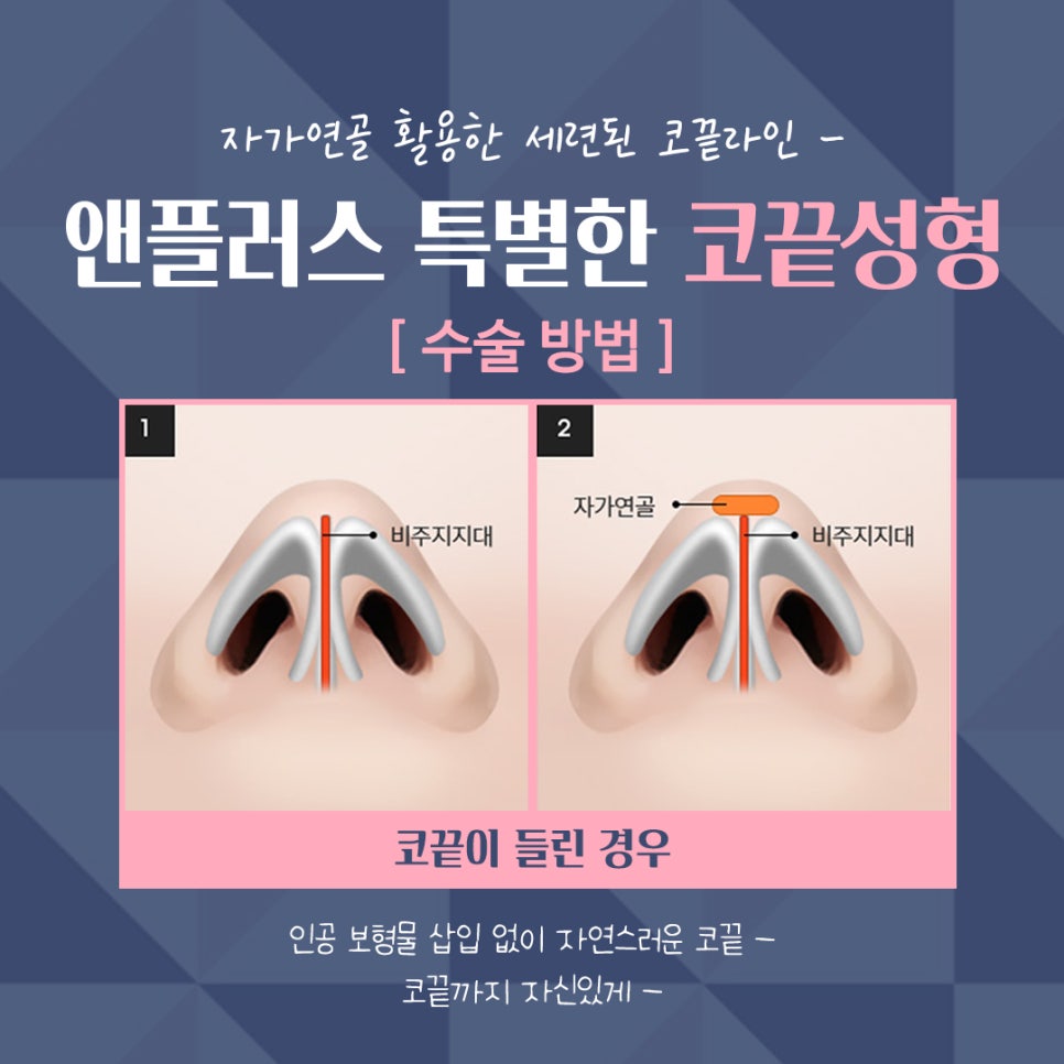 Nose Tip Surgery Review Using Tip Cartilage Suturing image 10
