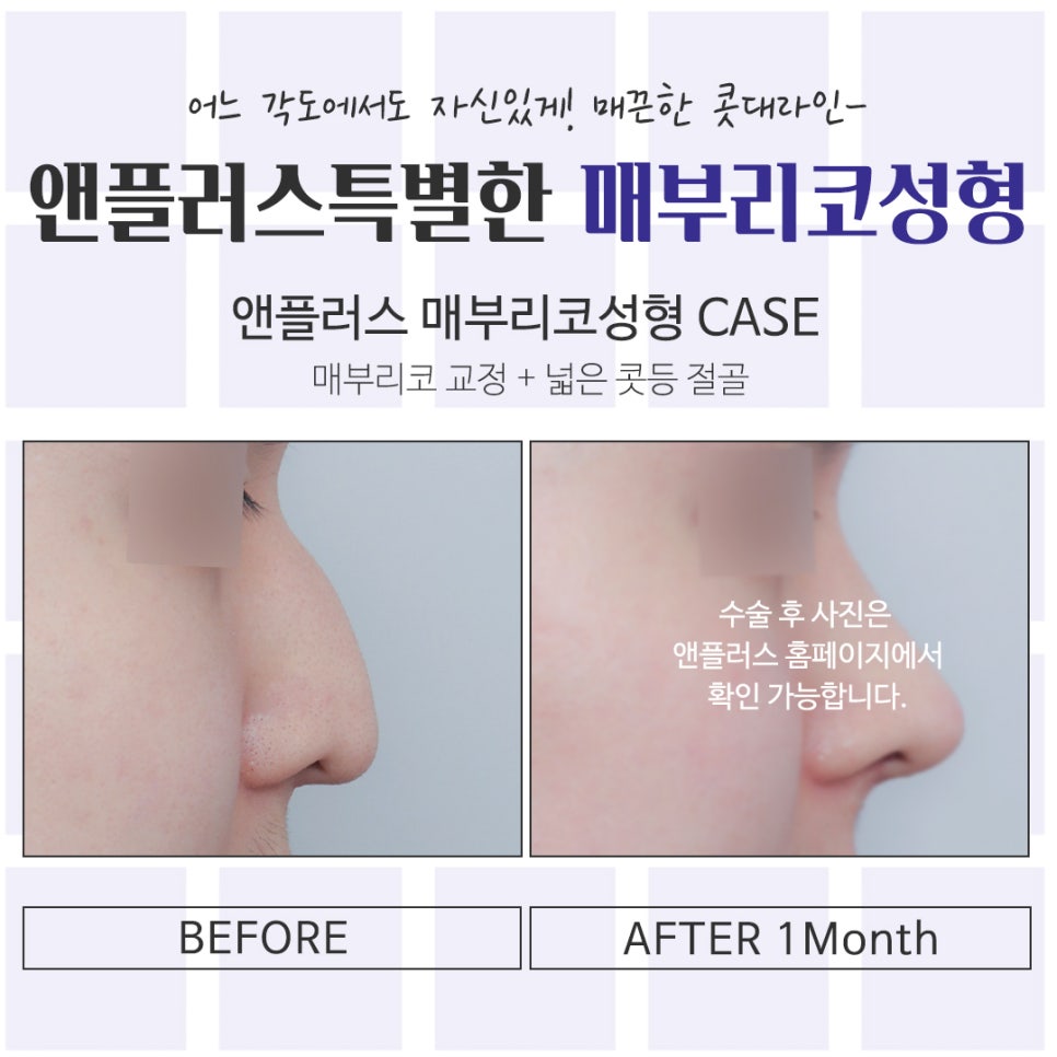 An Image Changed by Hump Nose Surgery Reviews image 15