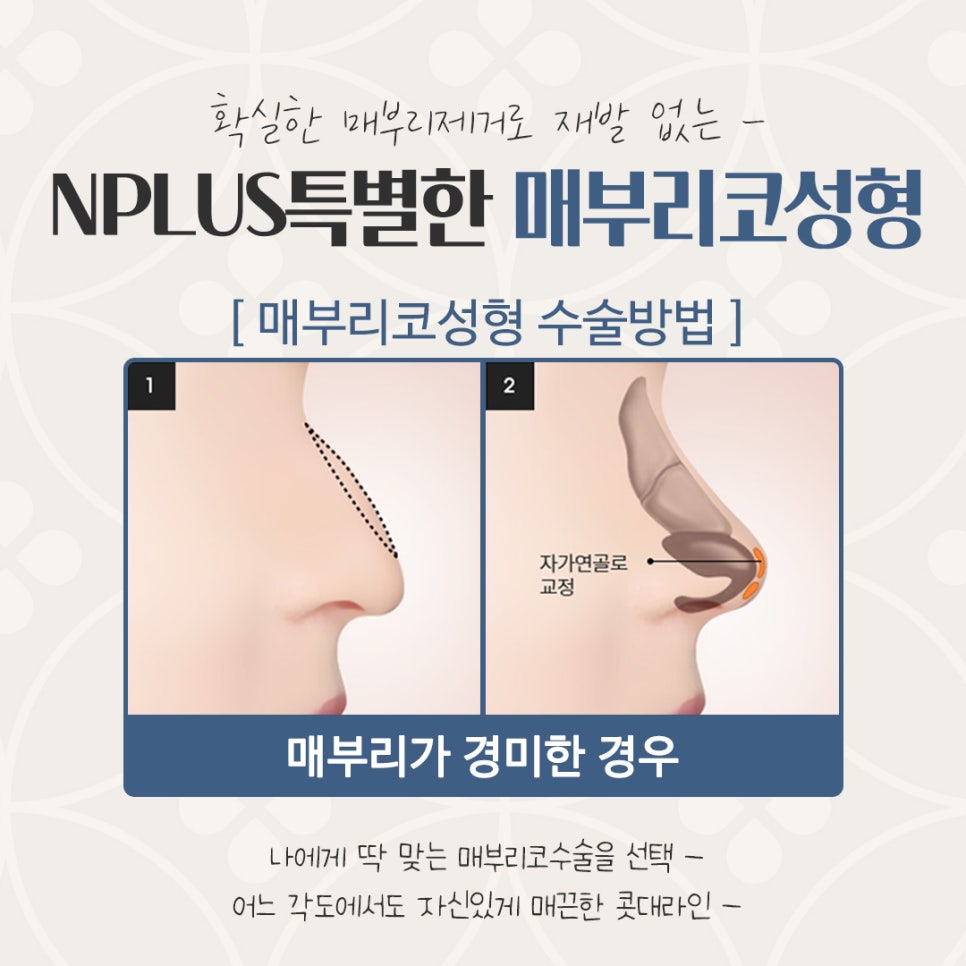 매부리코수술 후기까지 상세하게 알아보고 관련 이미지 10