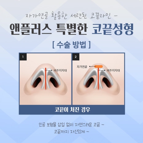 Looking into Comparisons of Tip Rhinoplasty Reviews image 10
