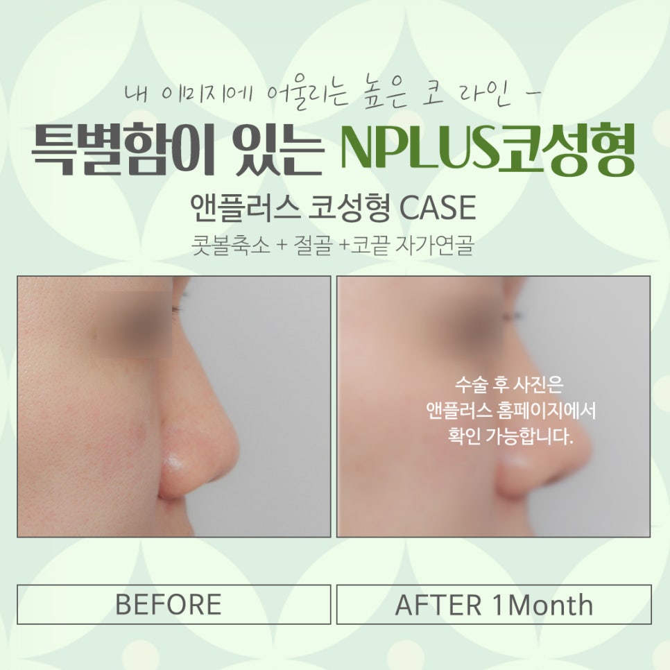 코수술잘하는병원을 찾아보고 관련 이미지 15