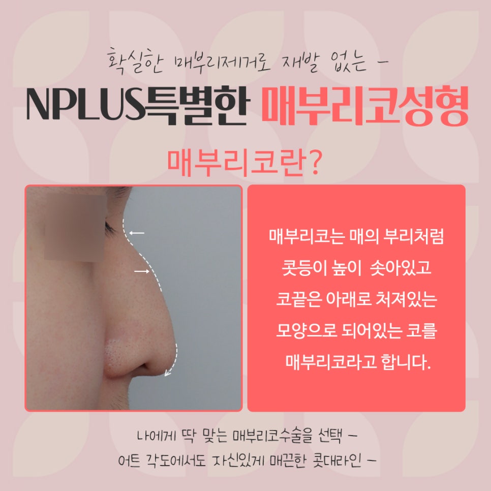 매부리코수술후기 자세하게 알아봐야 관련 이미지 4