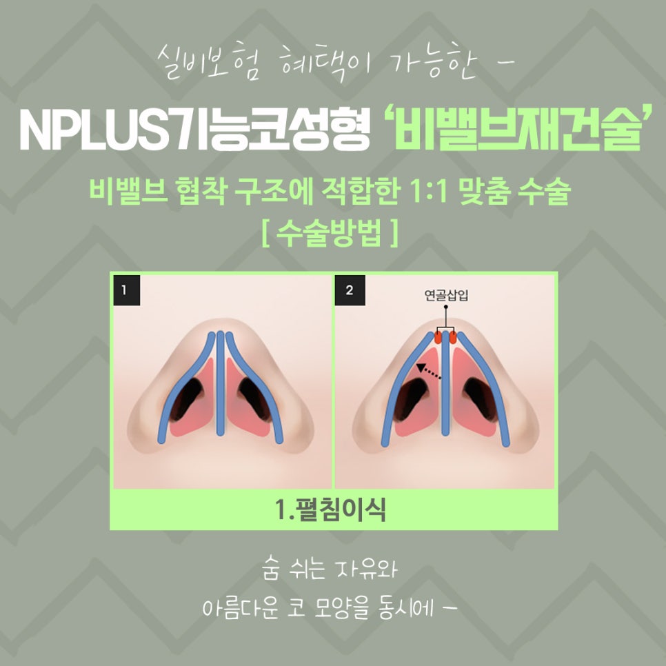 비밸브재건술을 통한 숨 쉬는 자유 관련 이미지 9