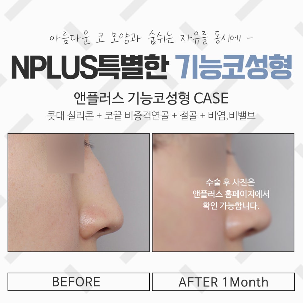 The Importance of Choosing Coverage for Nose Surgery image 13