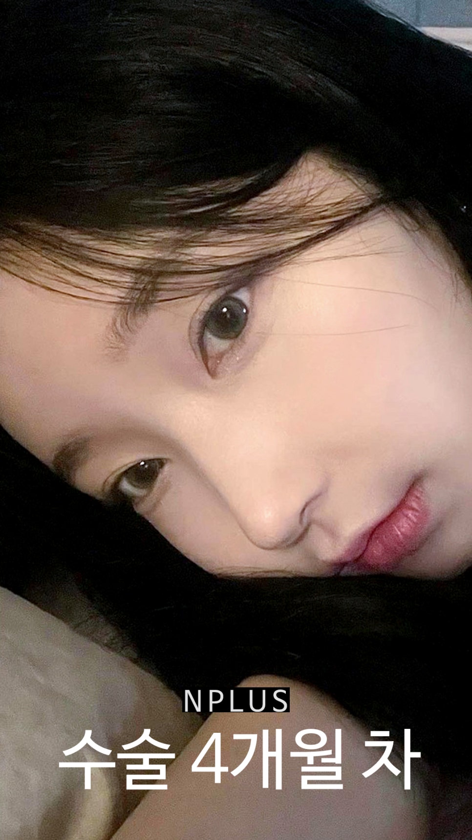 기본코성형후기 절골 + 무보형물 코성형 + 코끝 비중격 연골, 귀 연골 관련 이미지 12