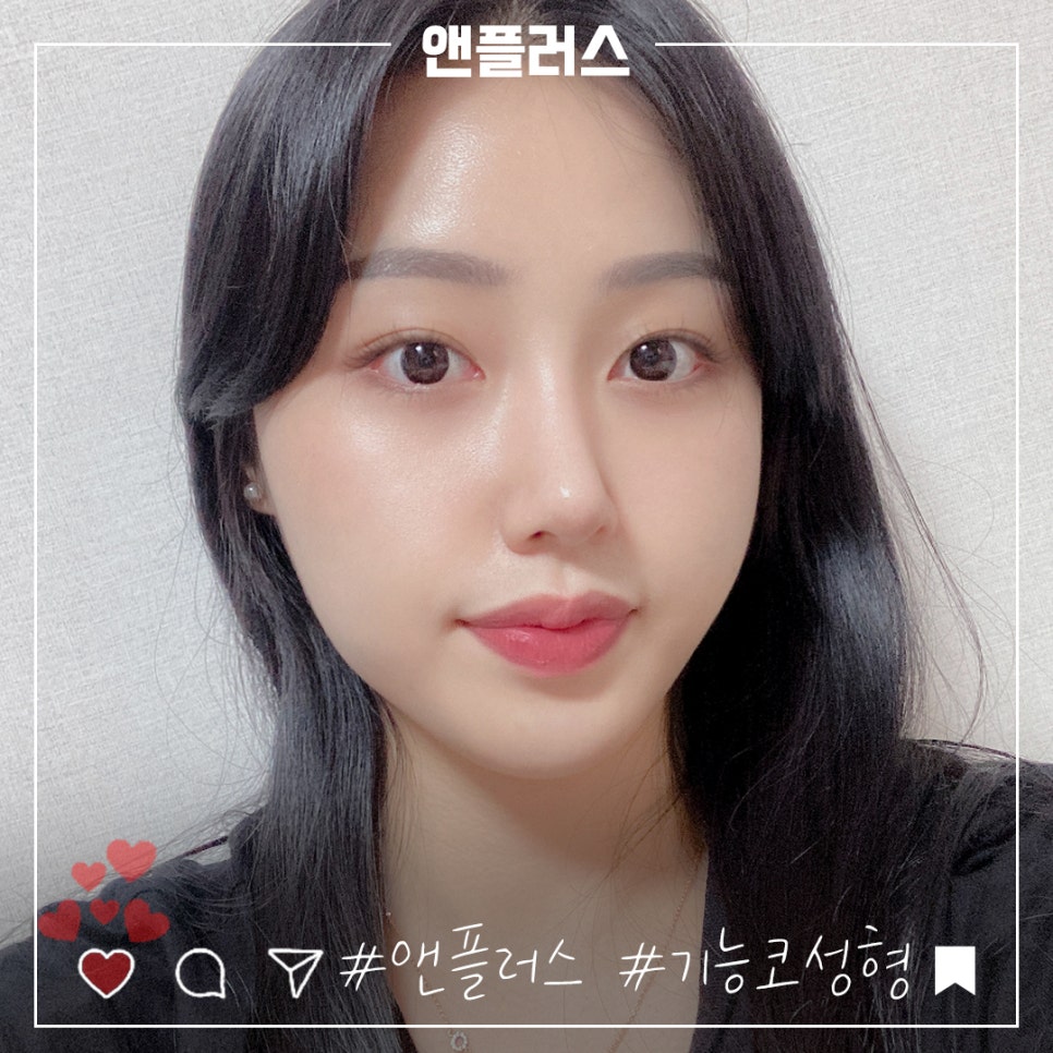 Before and After Female Nose Surgery in Various Ways image 1