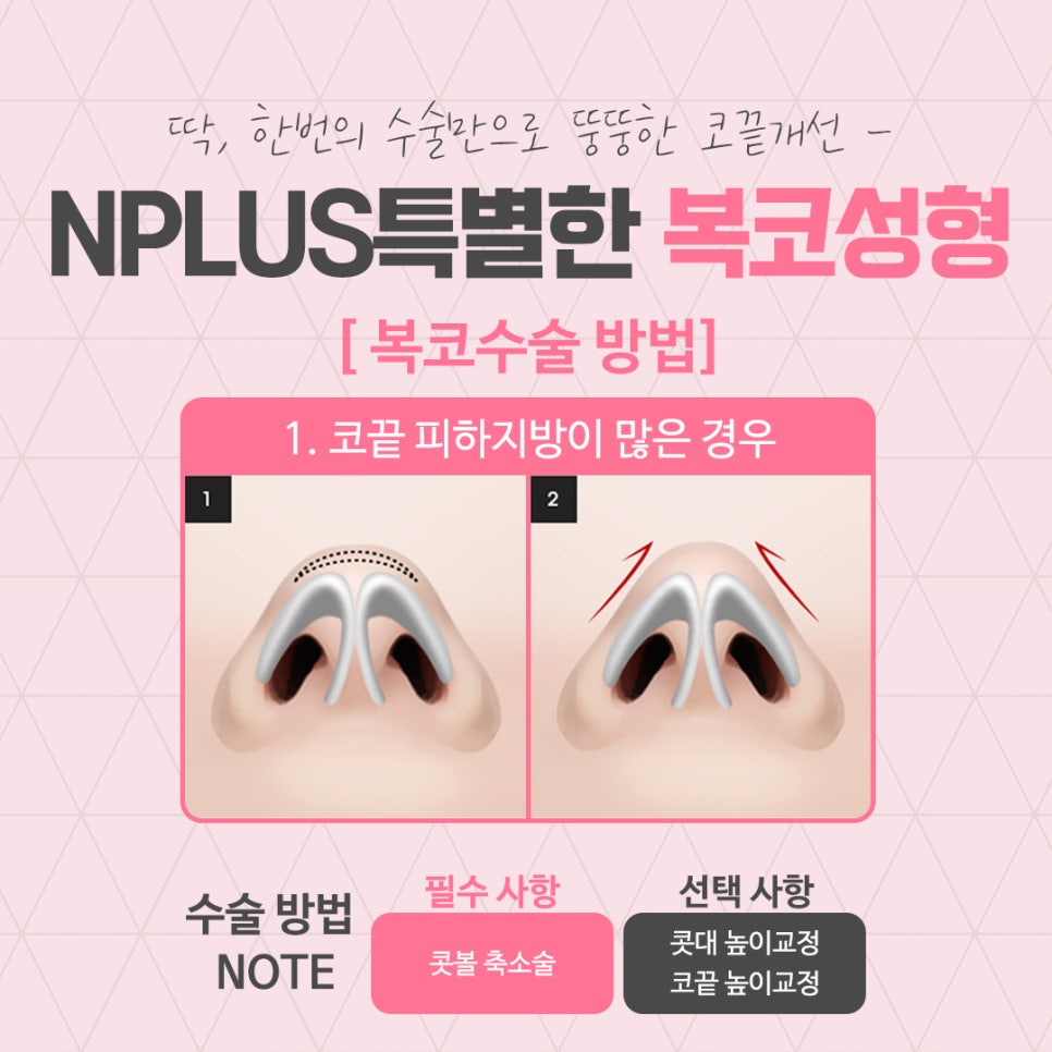 코지방제거를 통해 세련된 라인으로 관련 이미지 6