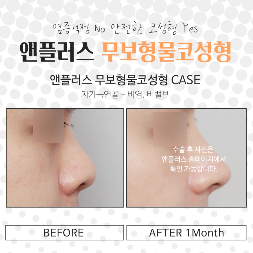 Sophisticated and Natural with Non-Implant Nose Surgery image 14