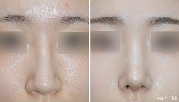 Hump Nose Osteotomy Surgery Review image 1
