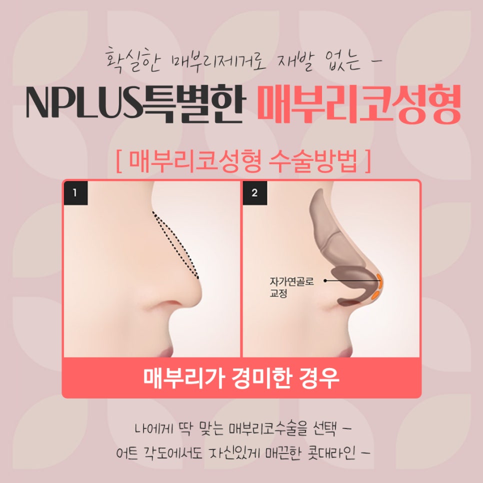 매부리코수술후기 자세하게 알아봐야 관련 이미지 11