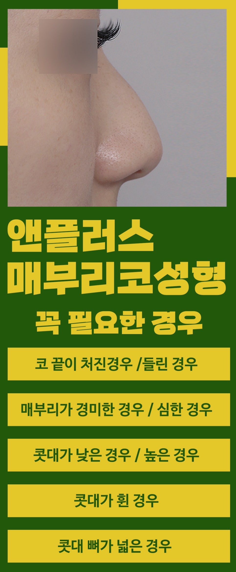 매부리코교정후기_깔끔하게 제거해야 관련 이미지 3