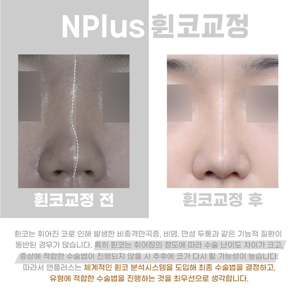 Crooked Nose Surgery Review_Confirmed Down to the Internal Structures image 7