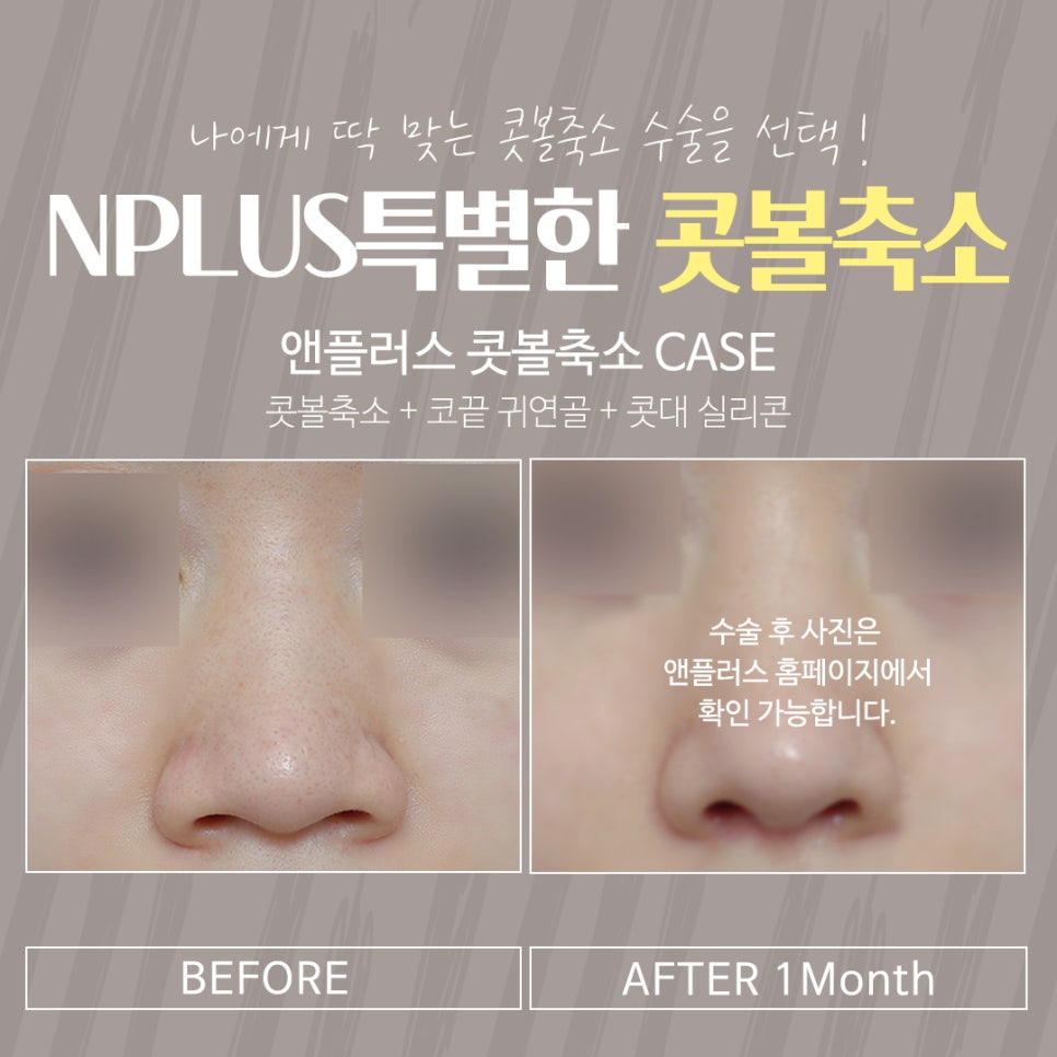 Postoperative Review of Nostril Reduction Surgery: If You’re Worried About Wide Nostrils image 4