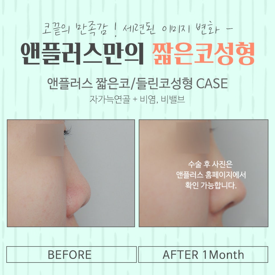 Short Nose Surgery with an Accurate Diagnosis image 16