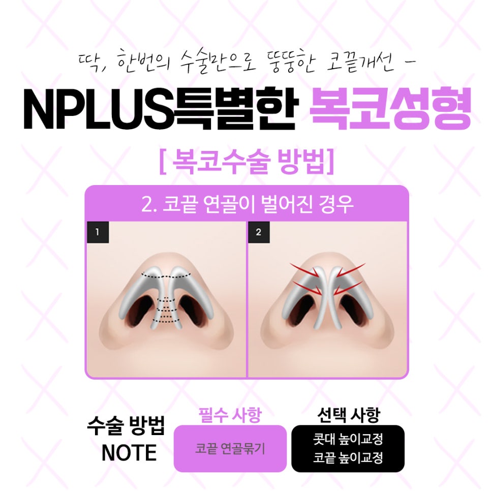 복코수술후기 자연스럽고 예쁜 라인으로 관련 이미지 8