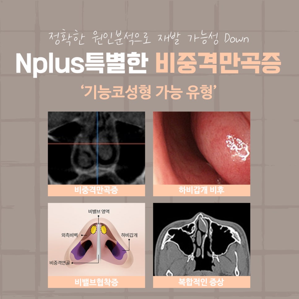 비중격만곡증수술후기 신중하게 고려하여 관련 이미지 4