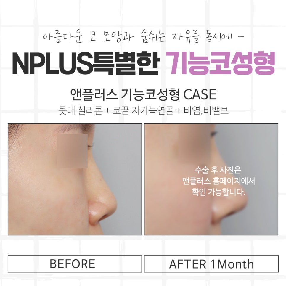 코성형후기 자연스럽고 아름답게 관련 이미지 13