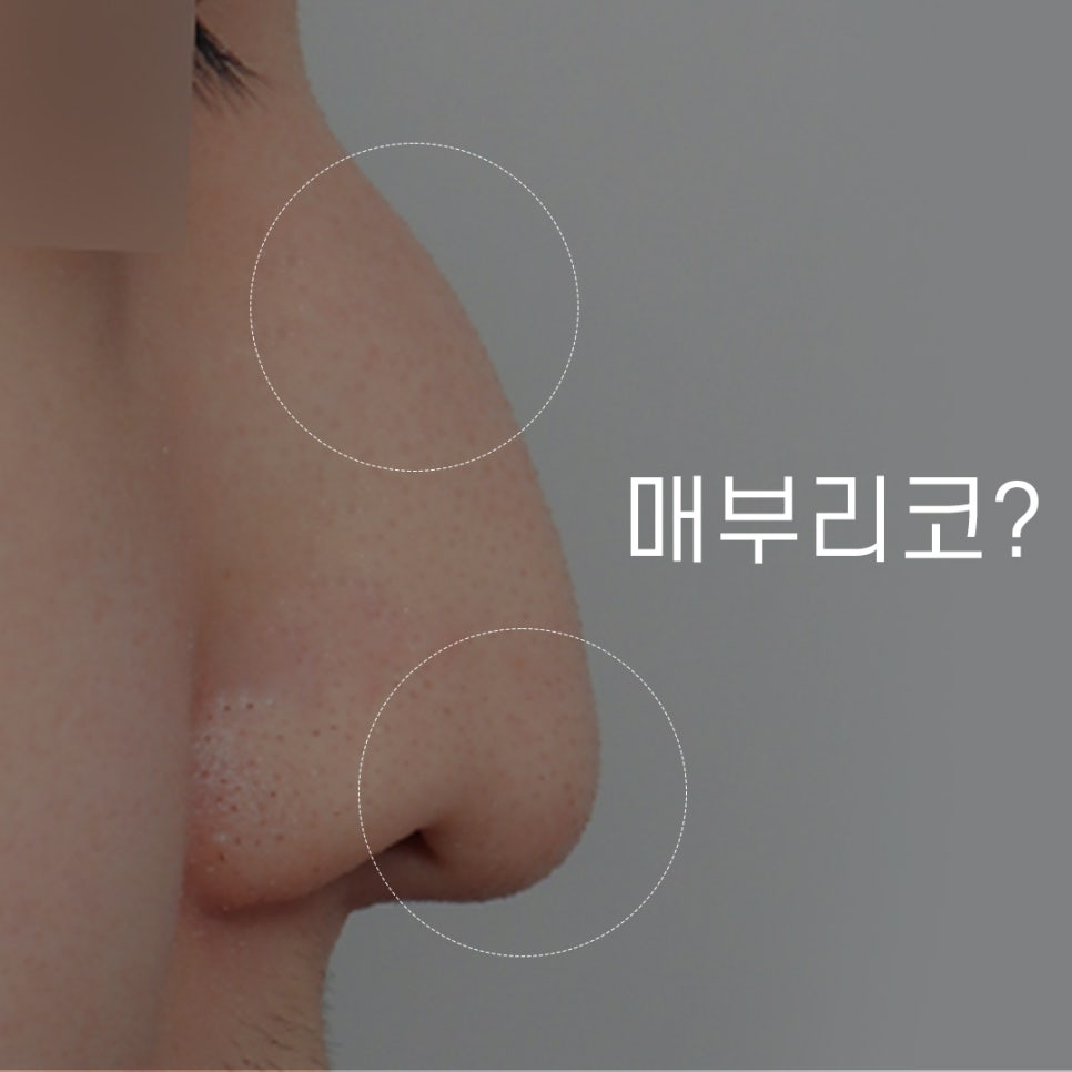 Hooked Nose Before-and-After Photos for a Softer Look image 1