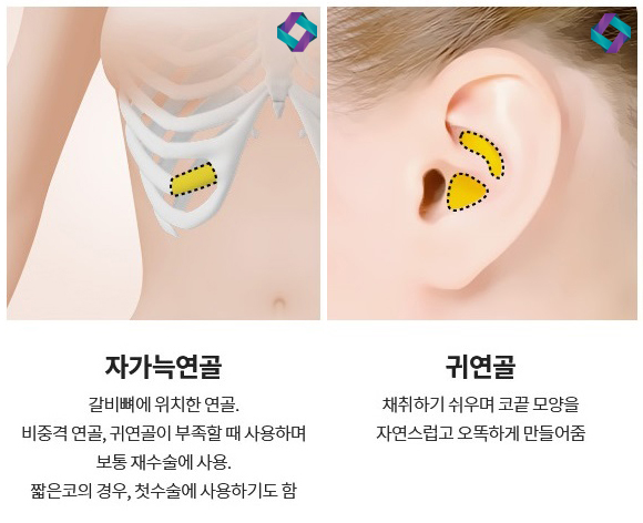 기능코성형 비중격만곡증(비중격교정술)과 코막힘원인 관련 이미지 12