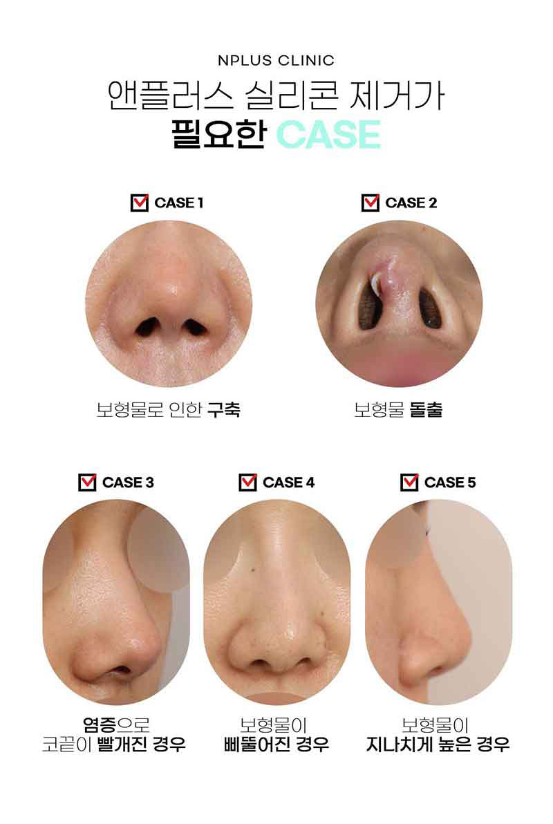 코실리콘제거를 통한 불편함 해소 관련 이미지 2