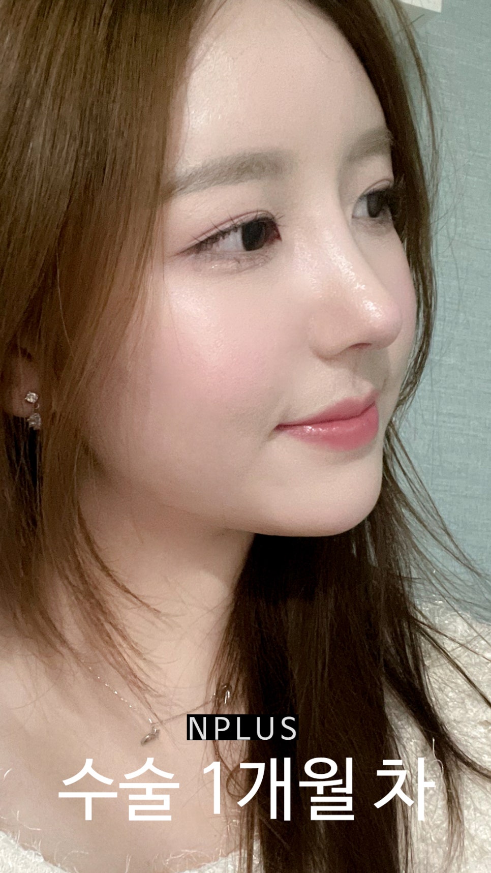 Short and Upturned Nose Shape Corrected with Autologous Rib Cartilage Nose Surgery at N Plus Clinic! image 8