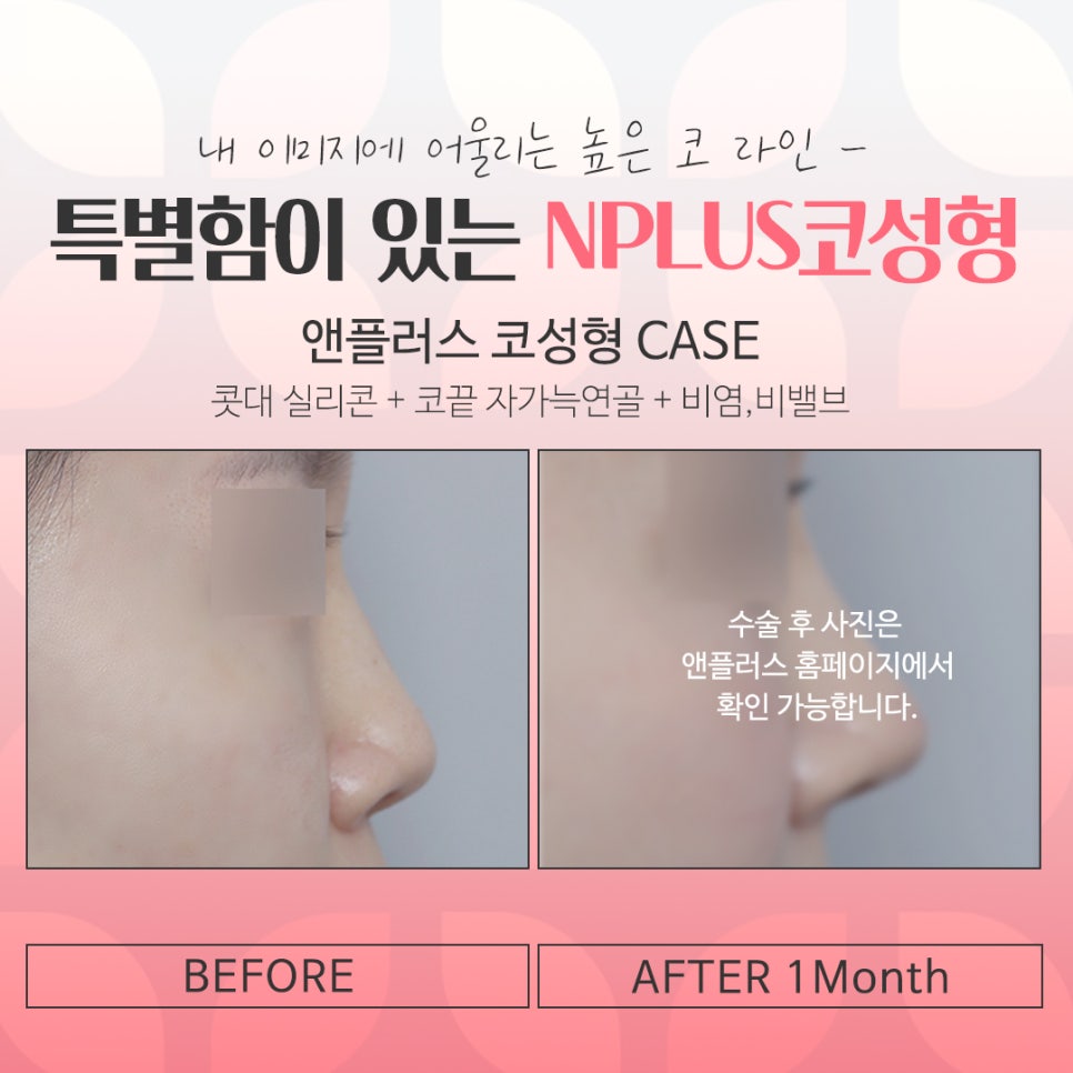 If You’re Looking for Detailed Reviews of Female Rhinoplasty image 17